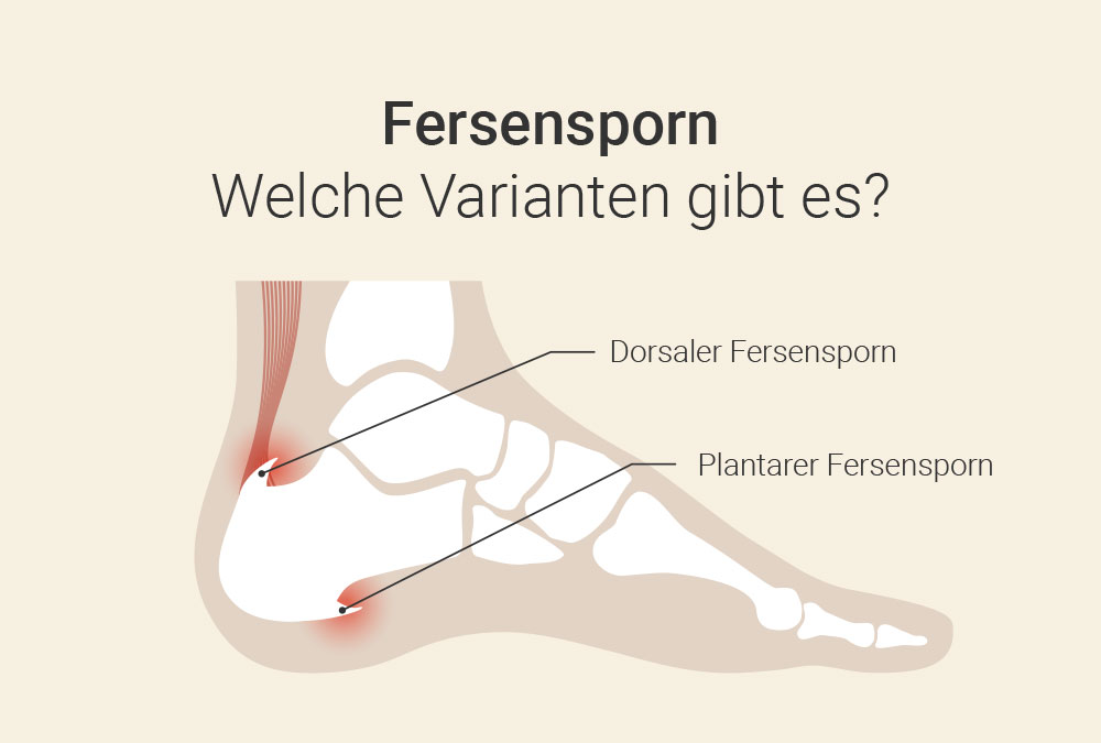 Stoßwellentherapie bei Fersensporn