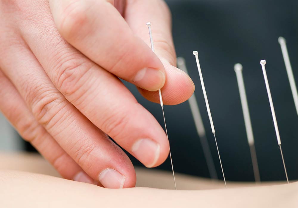 Akupunktur Rückenschmerzen