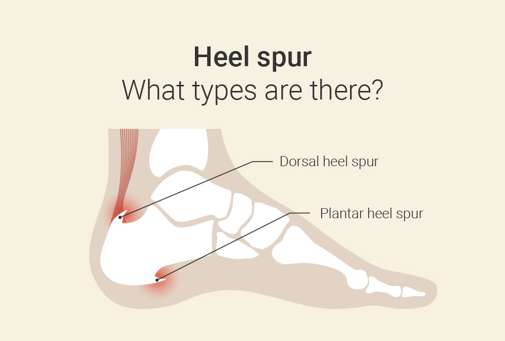 Shockwave therapy for heel spur