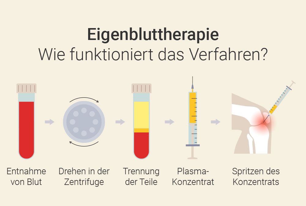 Eigenbluttherapie bei Arthrose