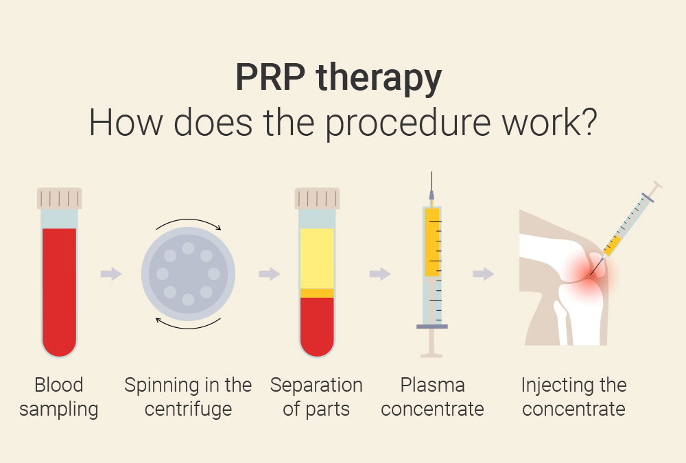 PRP therapy for osteoarthritis