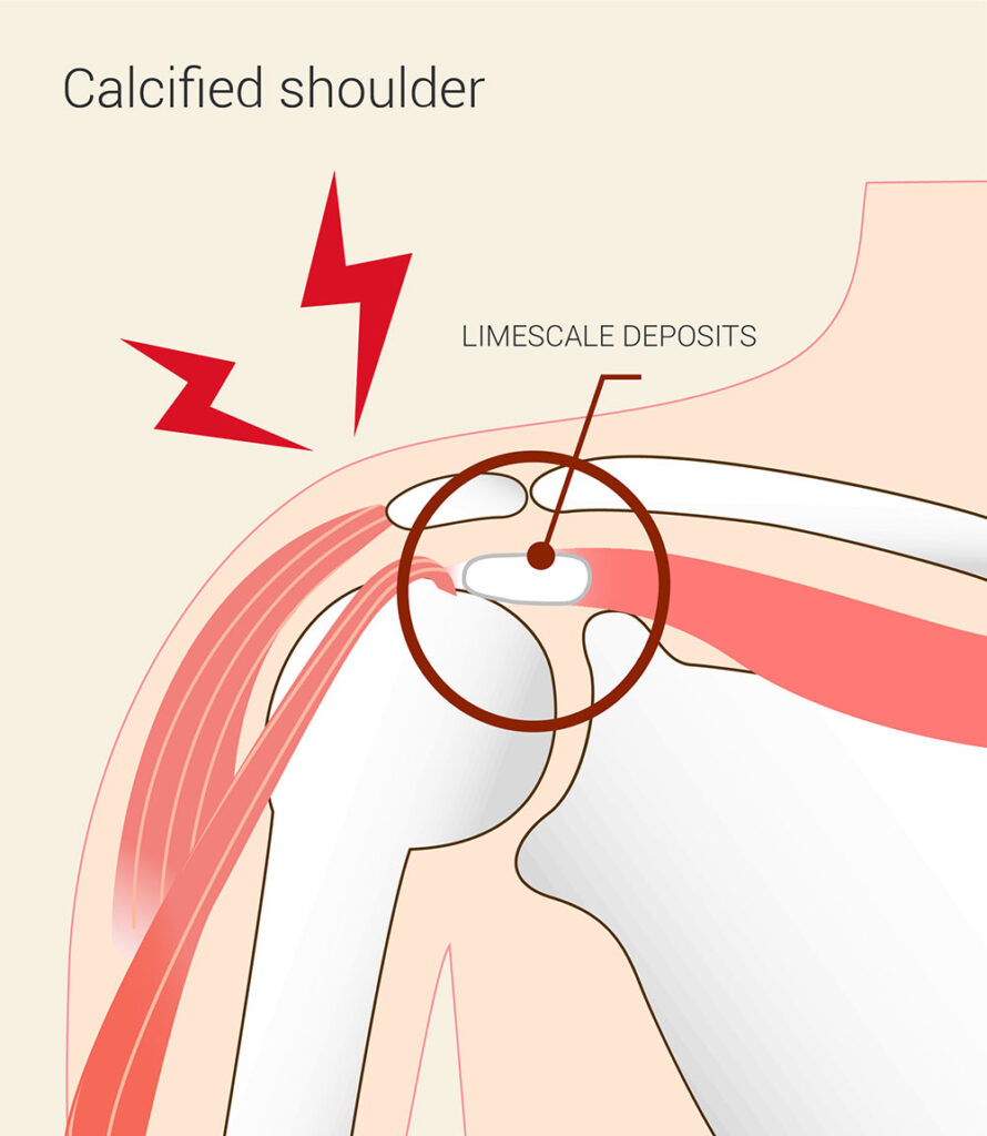 Kalkschulter Behandlung Frankfurt