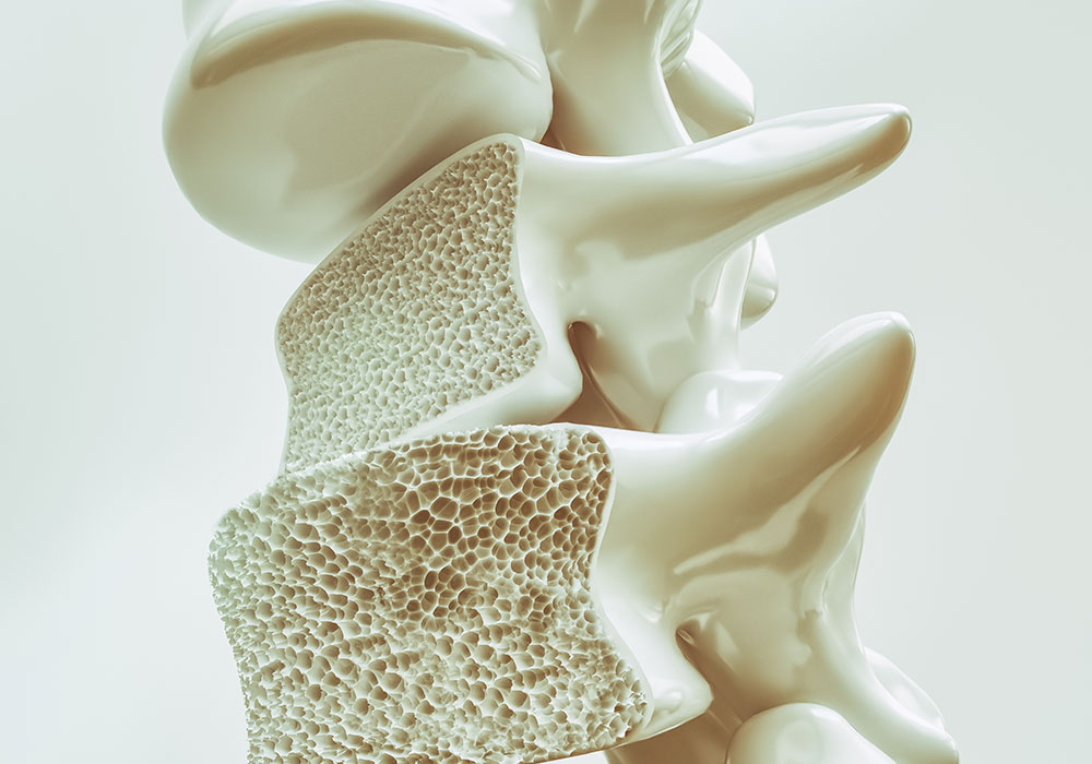 Therapie bei Osteoporose