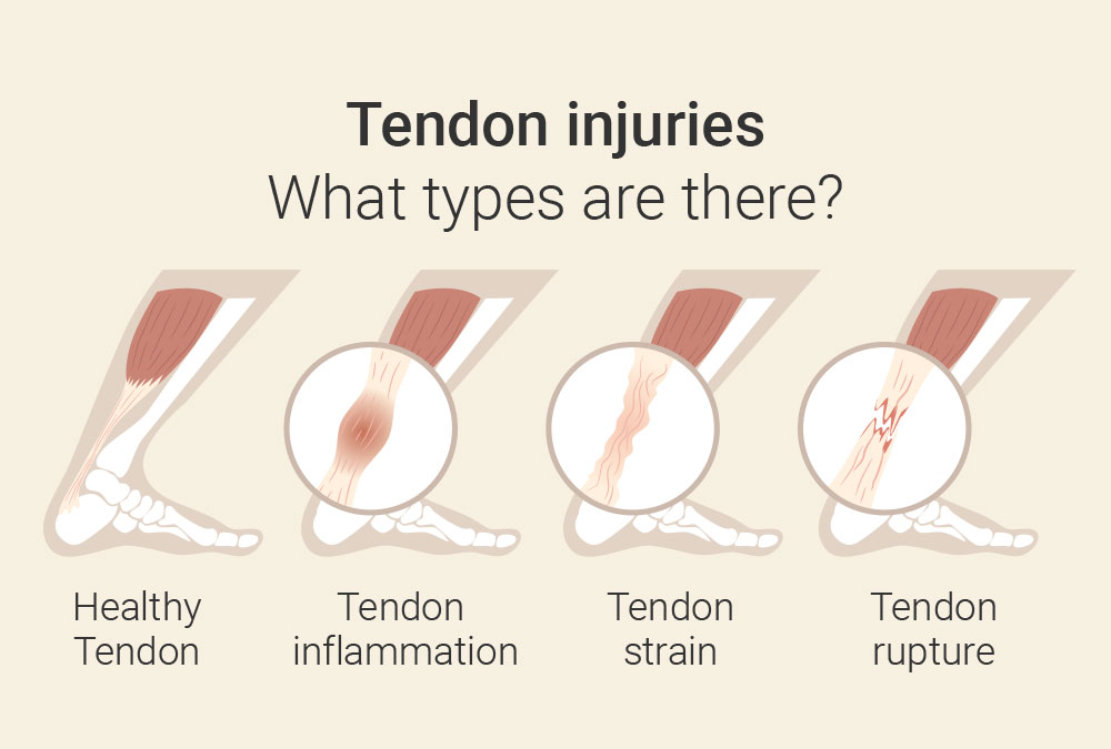 Tendon injuries Frankfurt