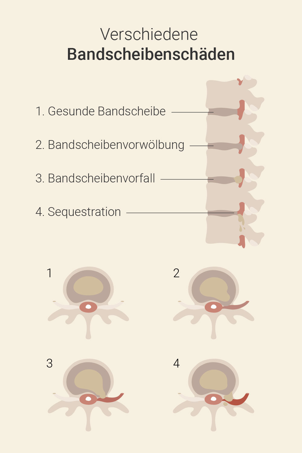 Bandscheibenvorwölbung behandeln