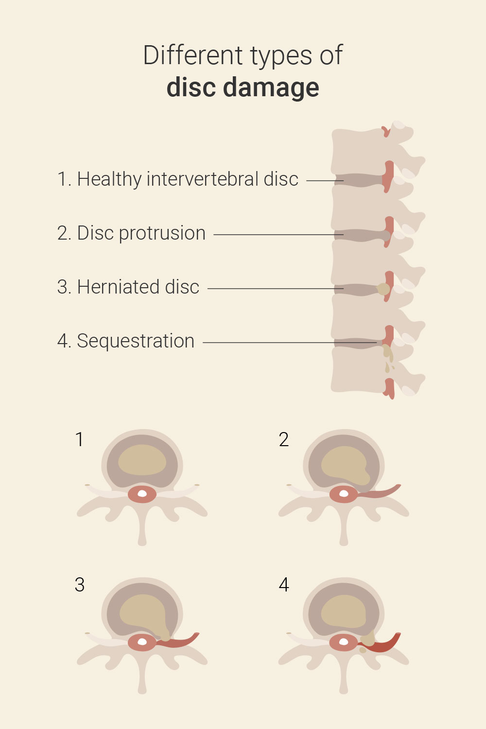 Treating a bulging disc