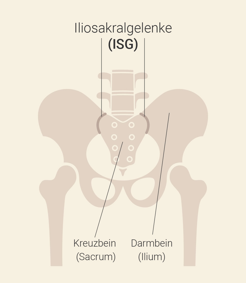 ISG Schmerzen