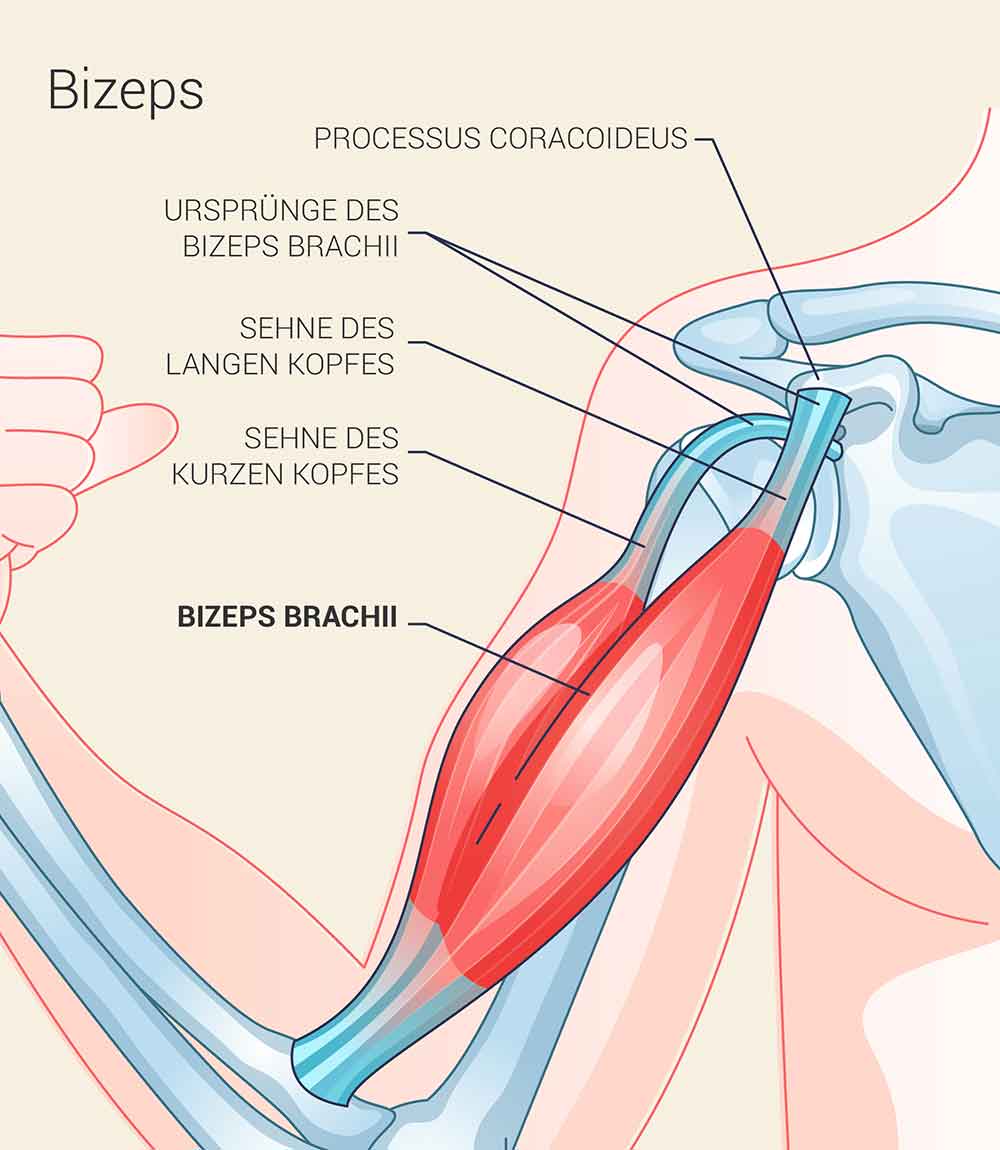 Bizepssehnenriss Behandlung