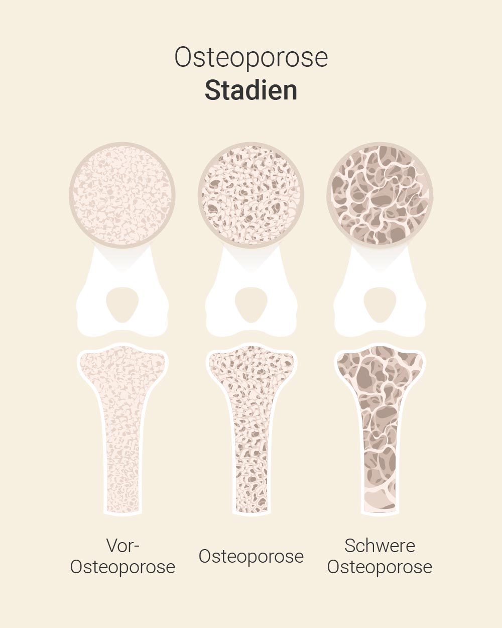 Osteoporose Stadien