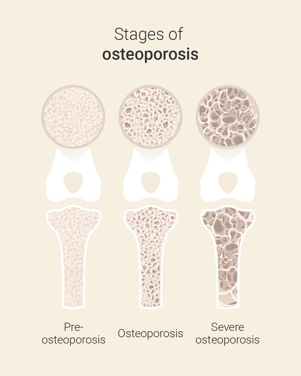 Osteoporosis Frankfurt | Stages of osteoporosis