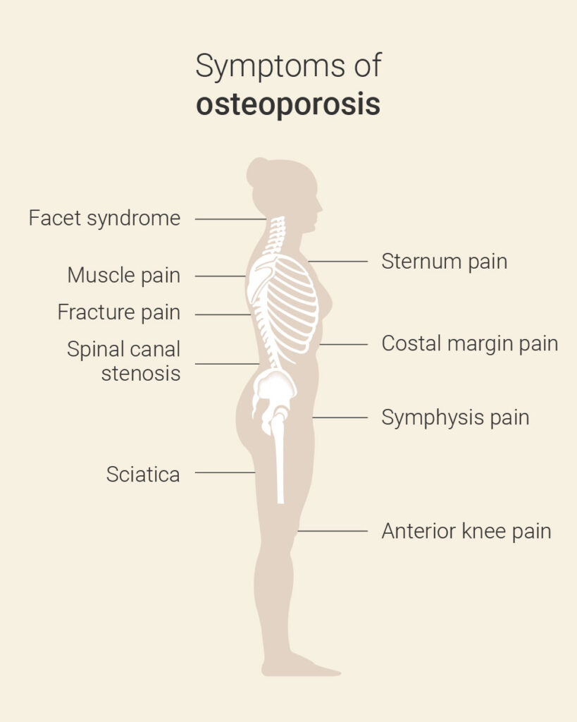 Osteoporosis Frankfurt | Osteoporose symptoms