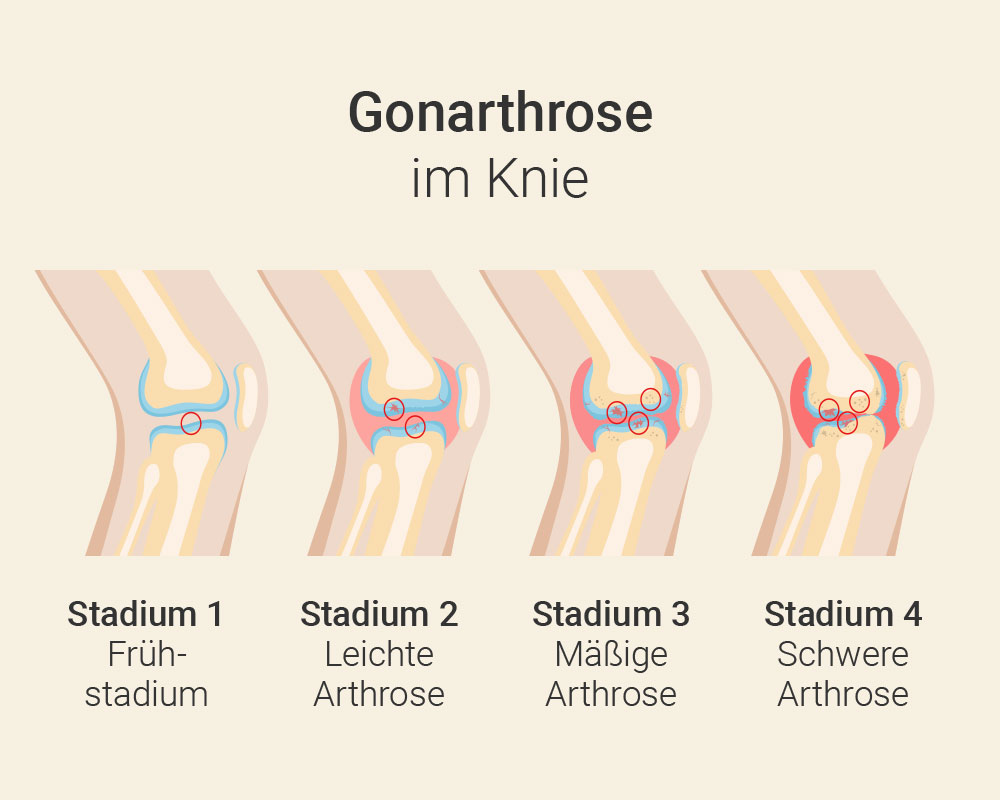 Gonarthrose im Knie