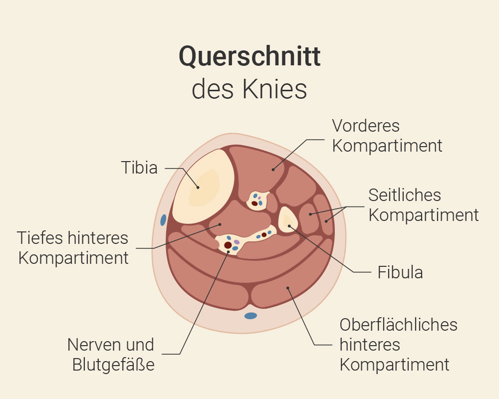 Gonarthrose im Knie
