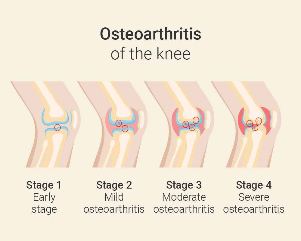 Osteoarthritis of the knee