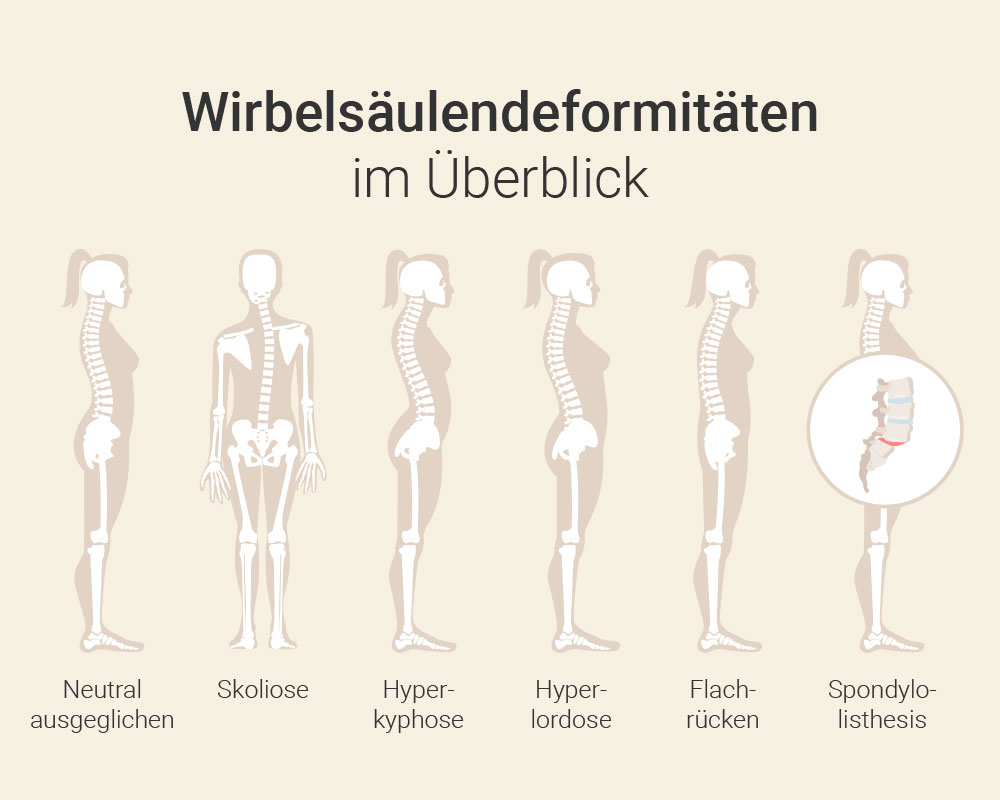 Wirbelsäulendeformität