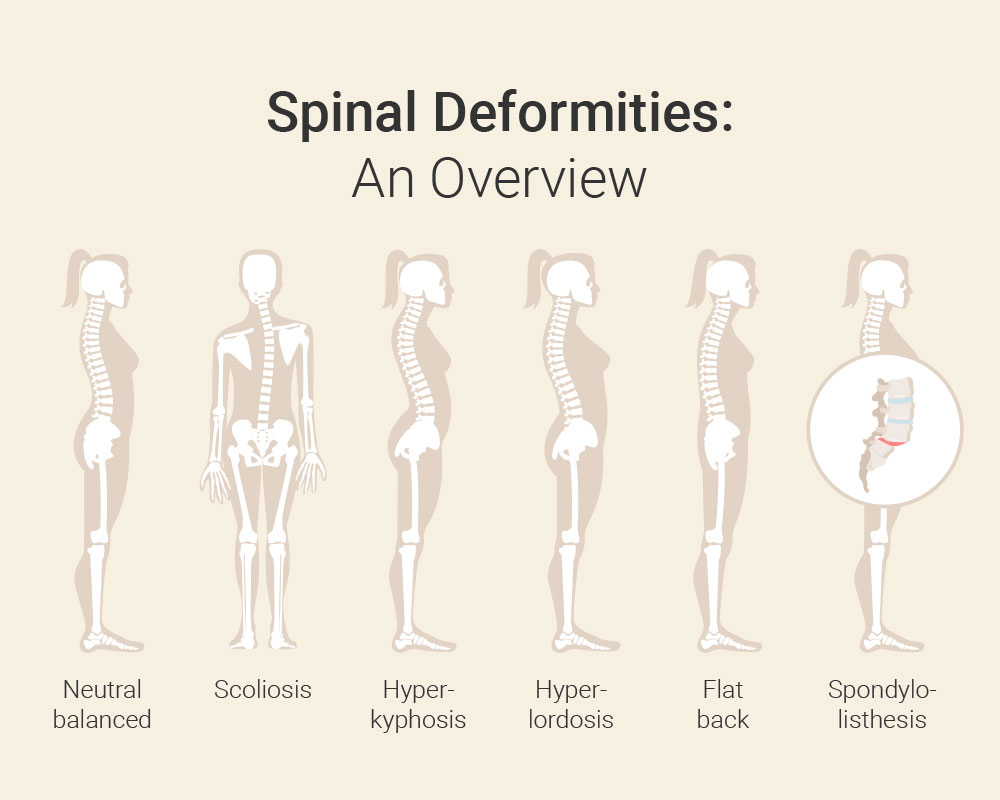 Spinal deformity