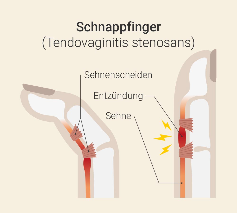 Schnappfinger Behandlung