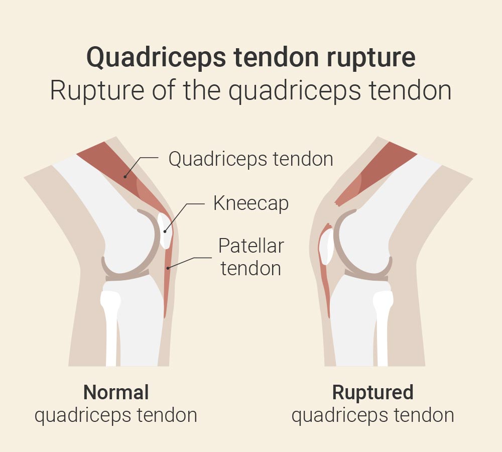 Quadriceps tendon rupture