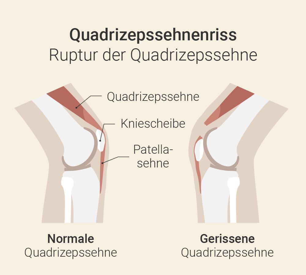 Quadrizepssehnenriss