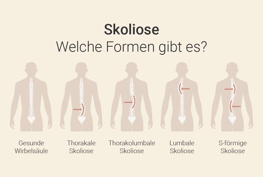 Formen von Skoliose