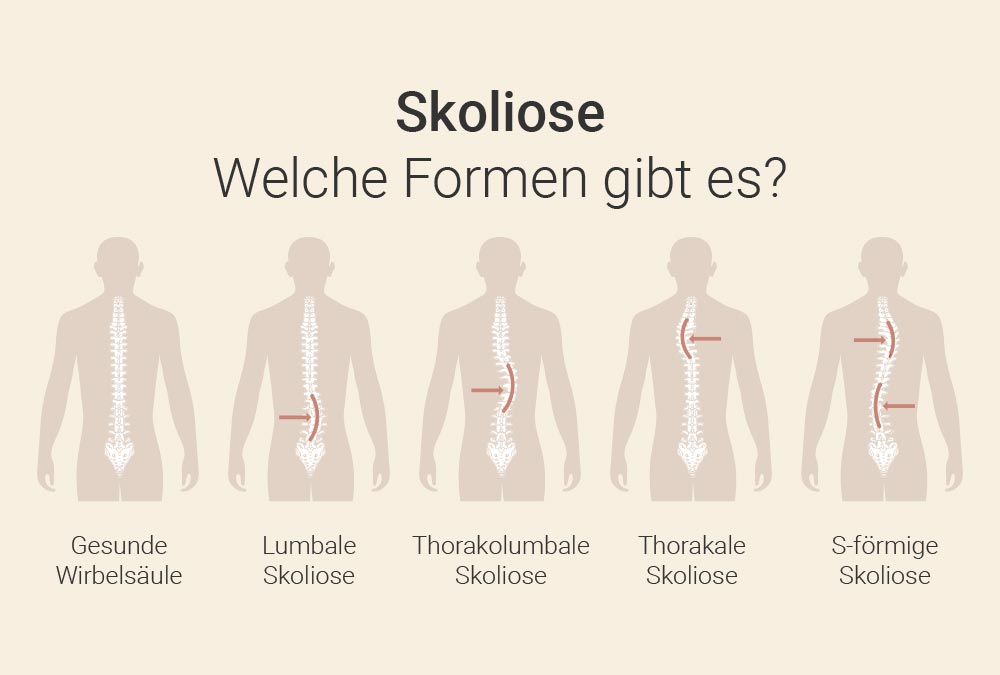 Formen von Skoliose