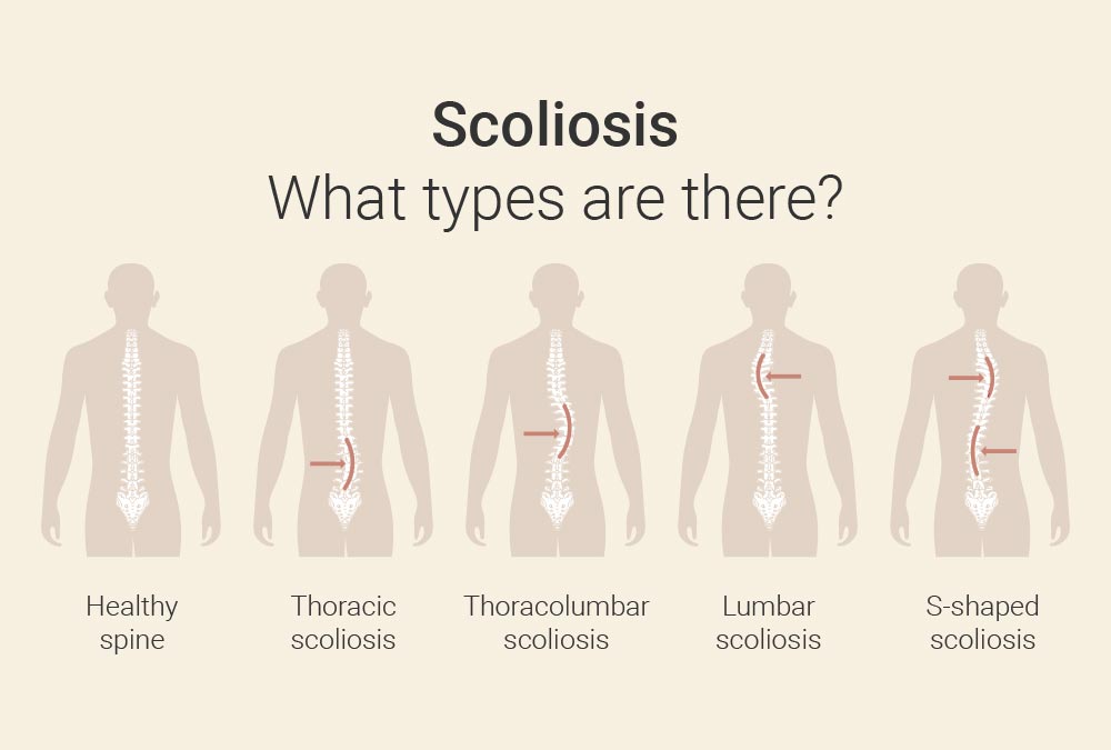 Types of scoliosis