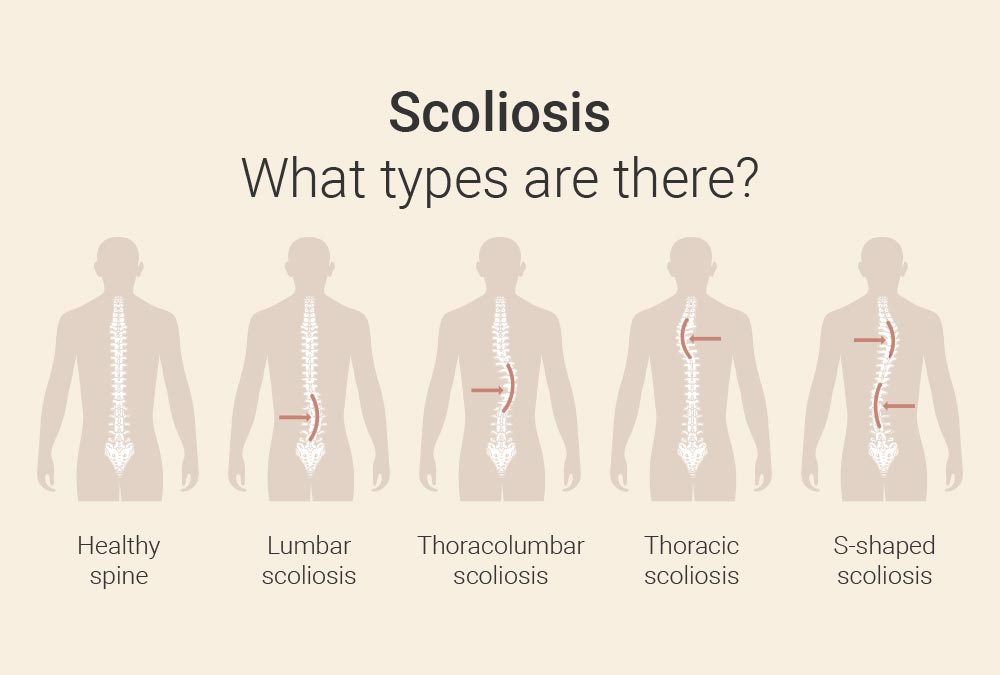 Types of scoliosis