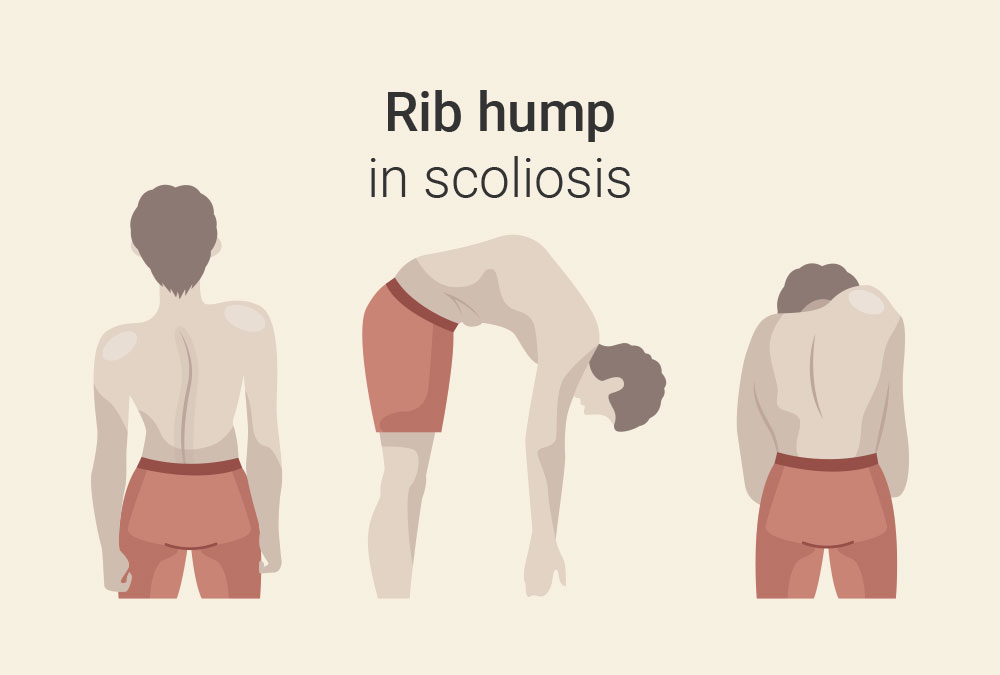 Rib hump in scoliosis