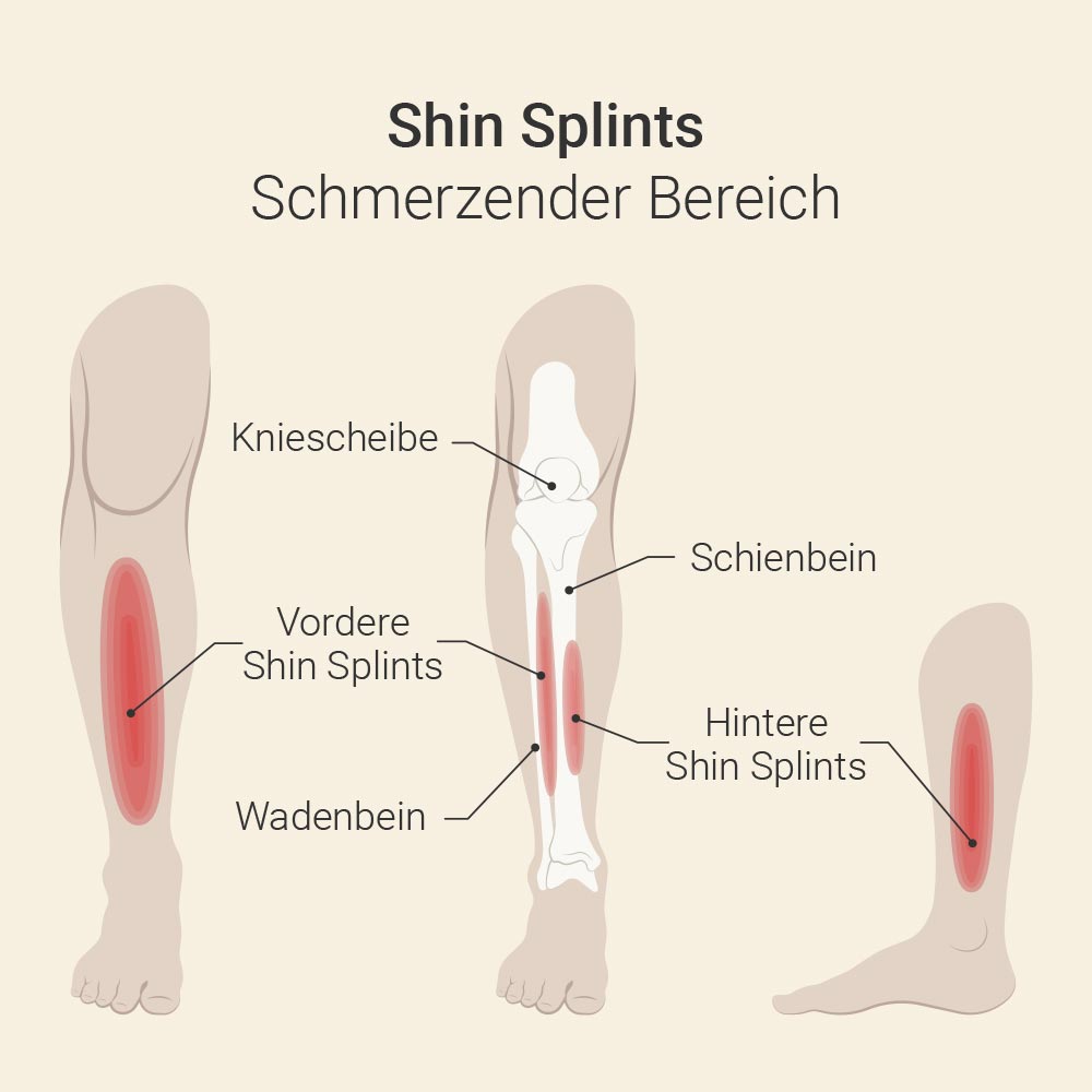 Shin Splints