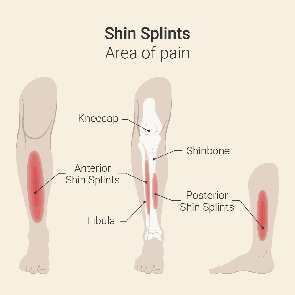 Shin Splints