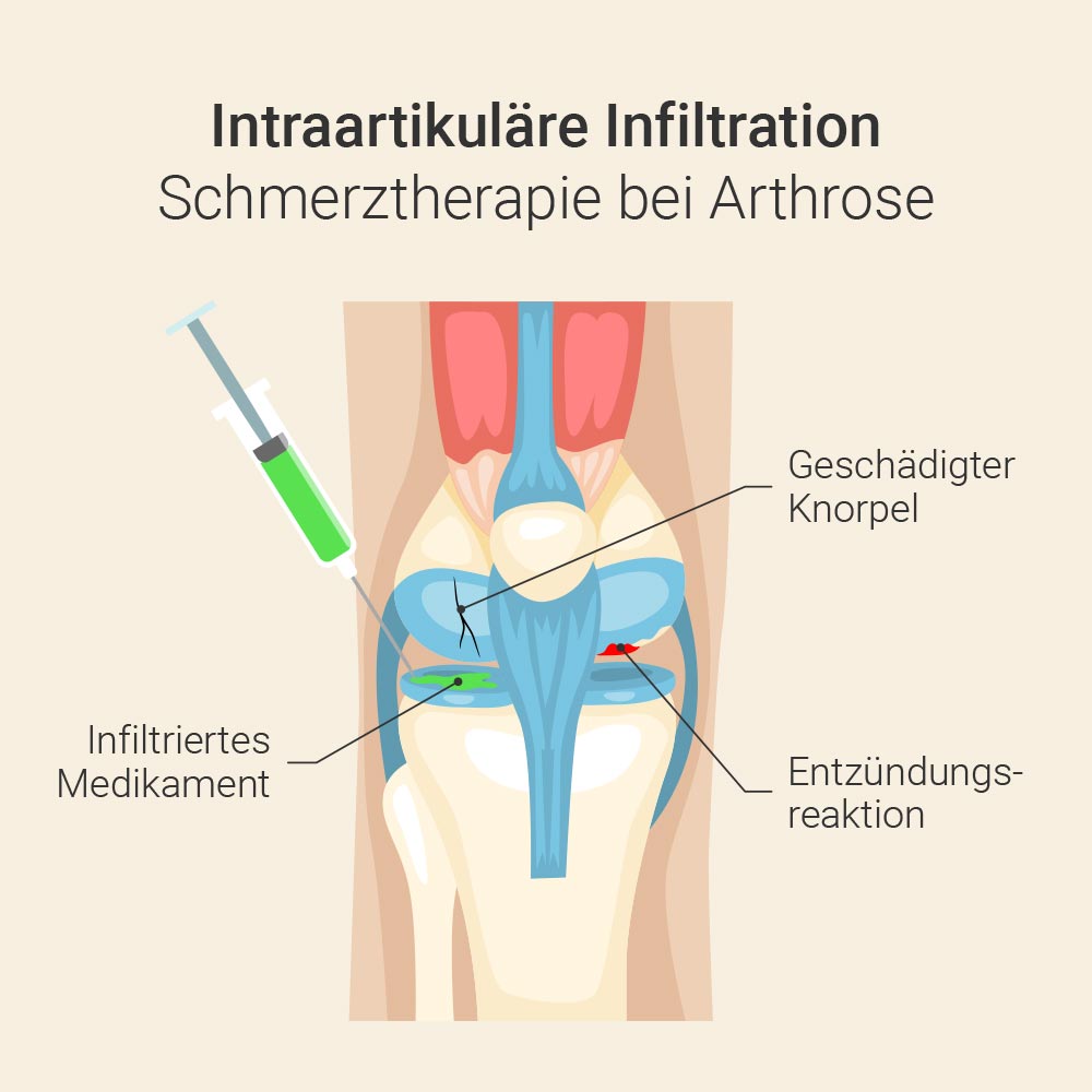 Intraartikuläre Infiltration