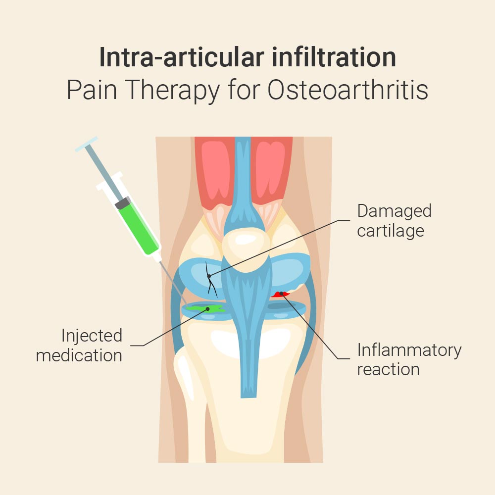 Intra-articular infiltration